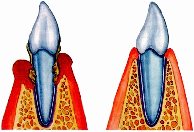 parodontitis (1)